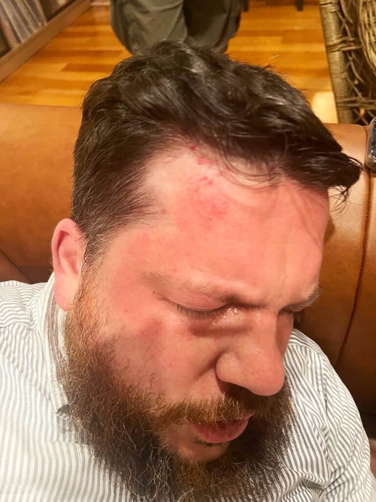 Navalny ally accuses ‘Putin’s henchmen’ of hammer attack, but vows not to give up