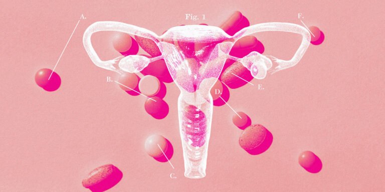 A hormonal condition that affects millions of women is difficult for doctors to diagnose and treat. Here’s why