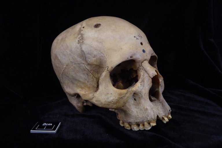 Ancient Egyptian skull shows oldest attempt at cancer surgery