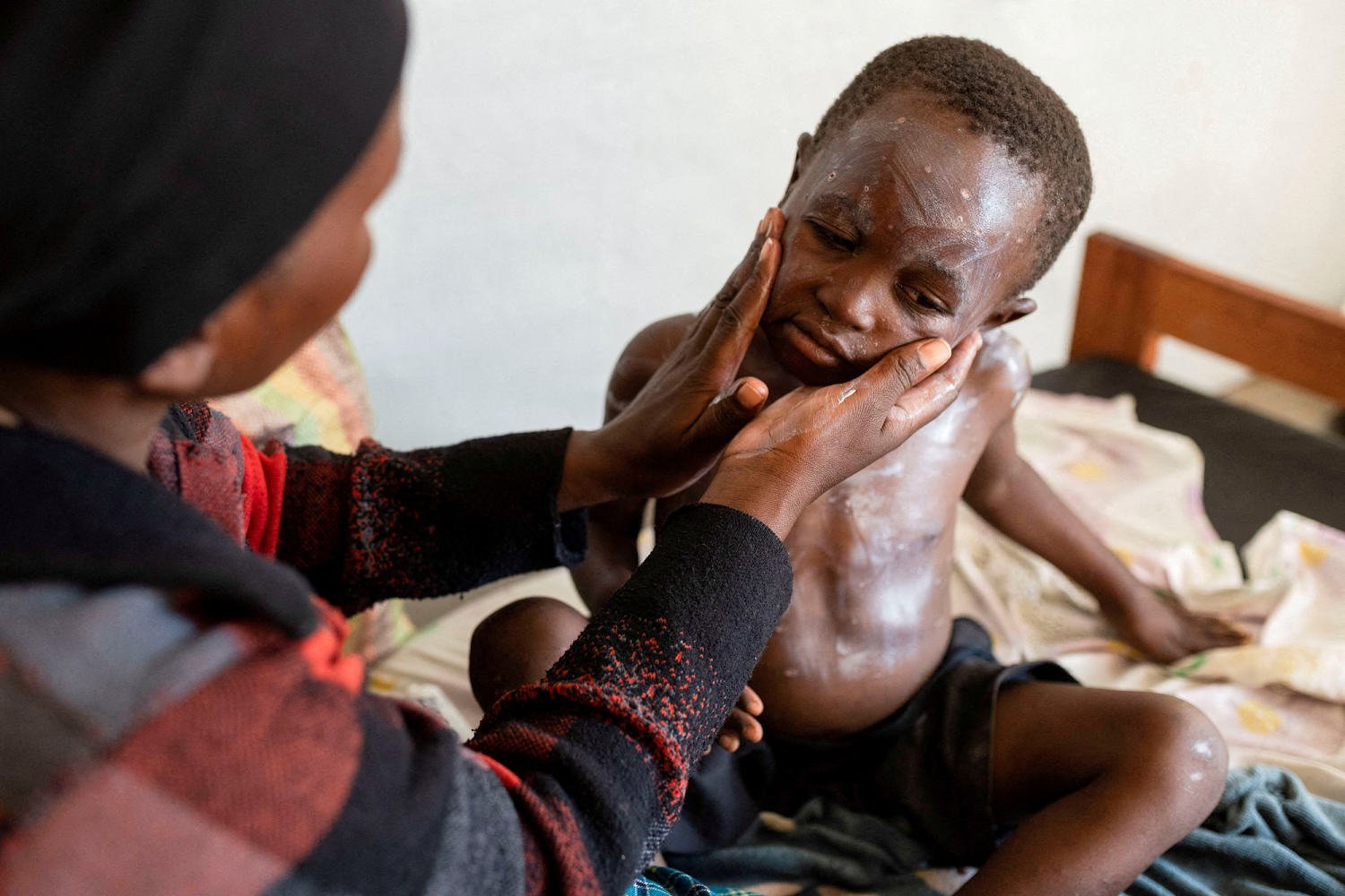 U.S. confirms first case of more aggressive strain of mpox